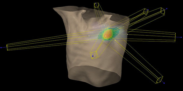 写真：肺がんに対する体幹部位定位放射線治療