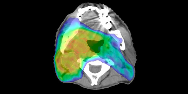 写真：頭頸部がんに対する強度変調放射線治療